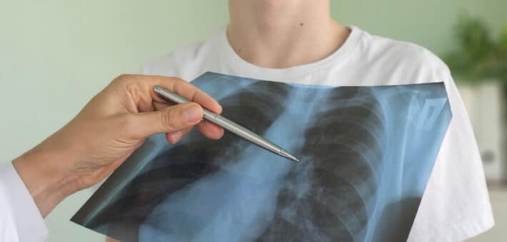 Cancer du poumon chez les femmes
